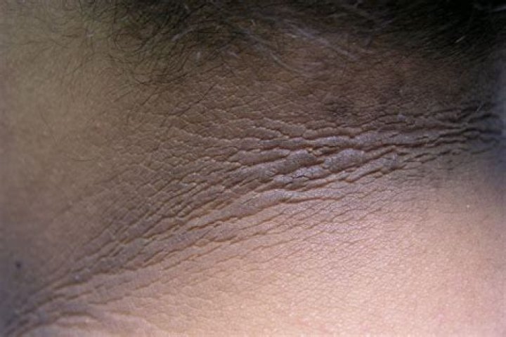 What is epidermal acanthosis?