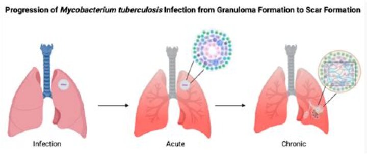 What is Fibrosis granuloma?