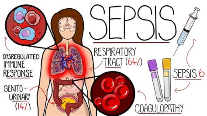What is full blown sepsis?