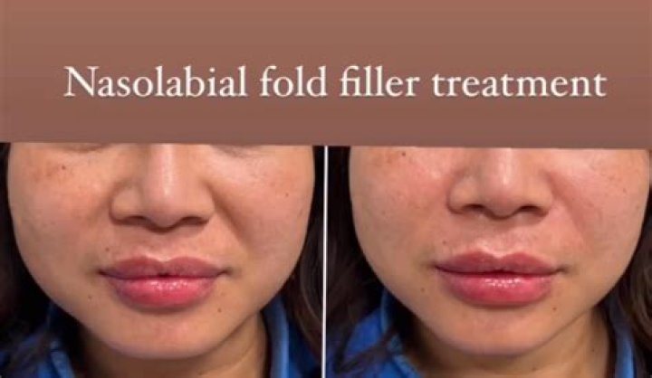 What is labial fold?