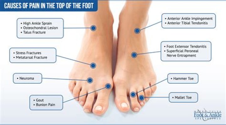 What is lupus foot pain like?
