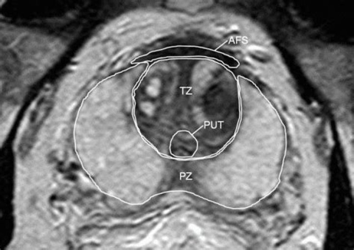 What is T2 on prostate MRI?