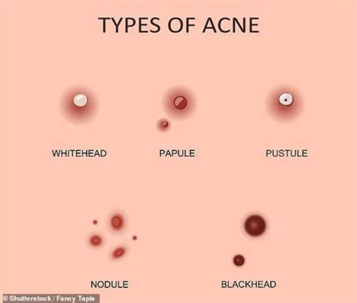 What is that hard white core in a pimple?
