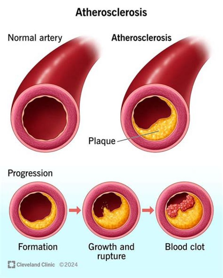 What is the fastest way to get rid of plaque in arteries?