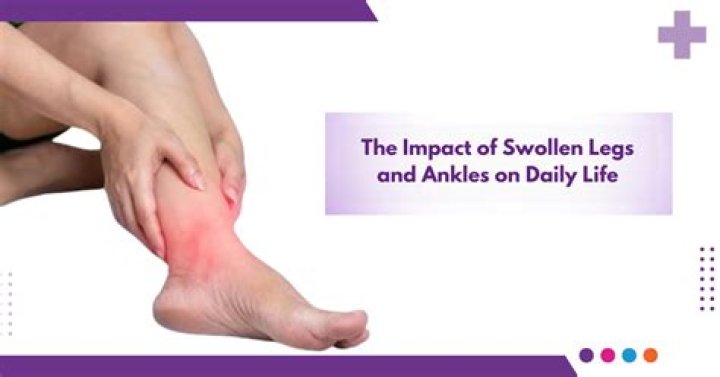 What is the main cause of swollen feet?