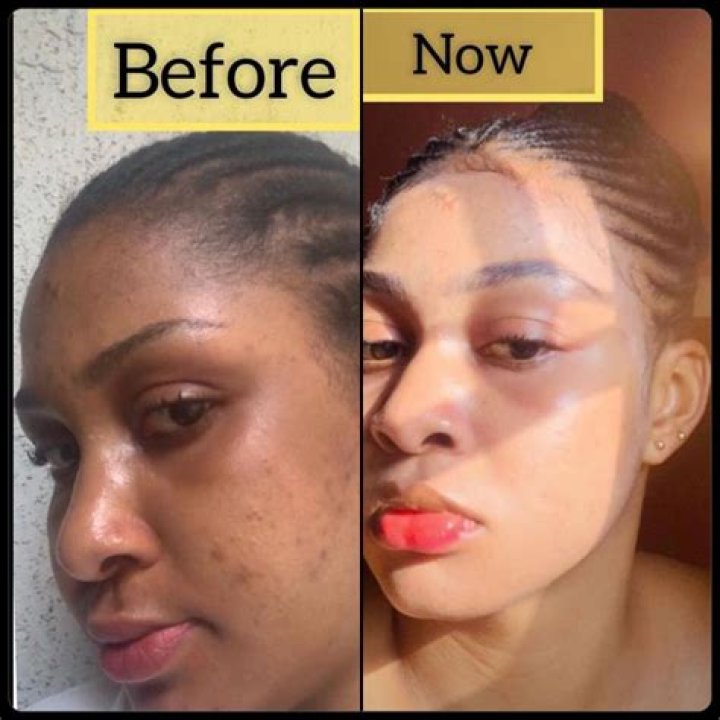 What is used to bleach skin?