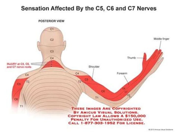 What nerves are affected by c5 C6?