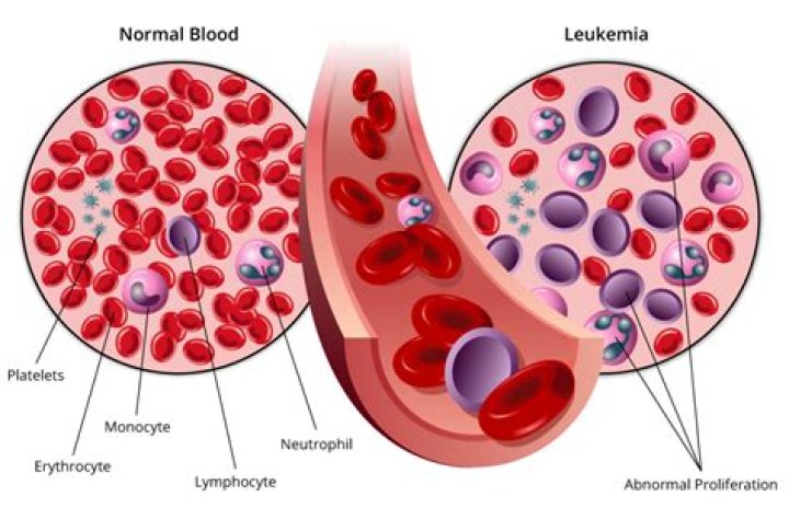 What organs are affected by leukemia?