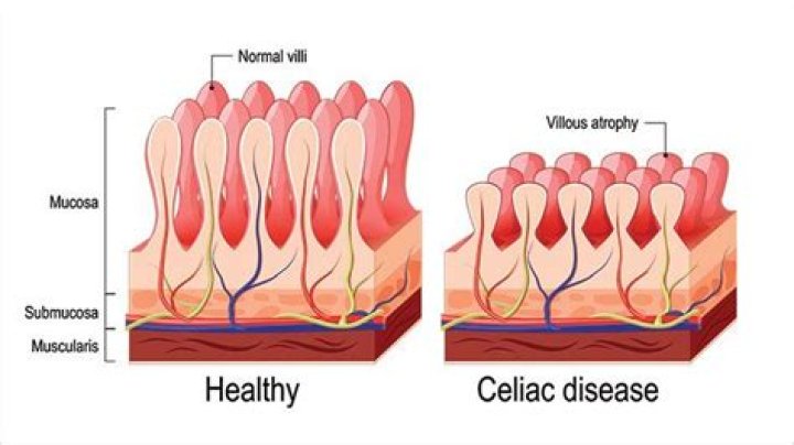 What part of the body does celiac disease affect?