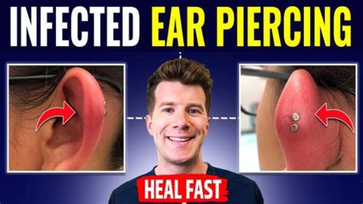 What piercing gets infected the most?