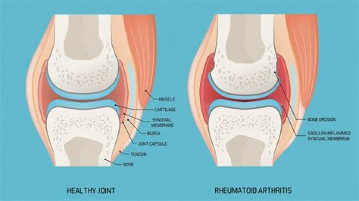 What should you not do if you have rheumatoid arthritis?