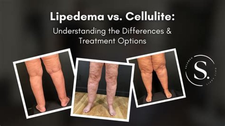 What supplements get rid of cellulite?