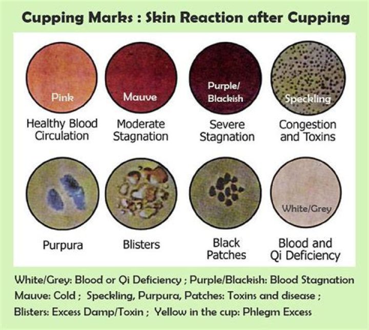 What to expect after cupping?