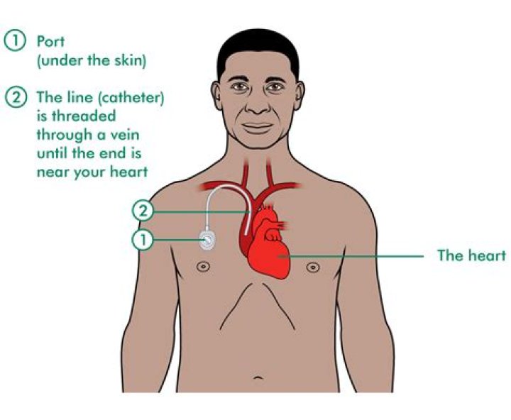 What vein does a chemo port go into?