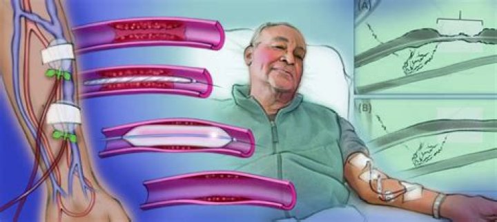 When do you stop dialysis?