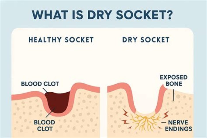 When is the chance of dry socket gone?