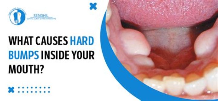When should I worry about a lump in my mouth?