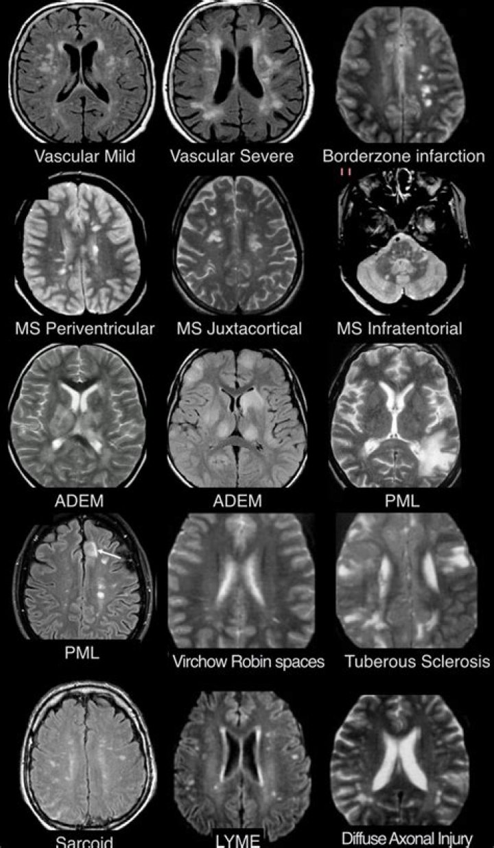 Where are lesions most common in MS?