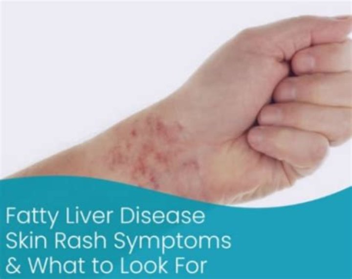 Where do liver rashes appear?