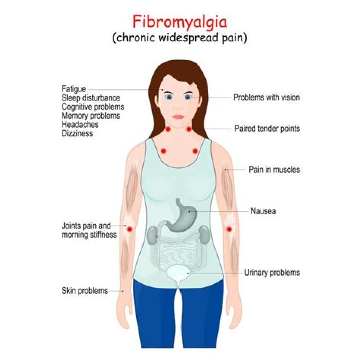 Where do you feel fibromyalgia pain?