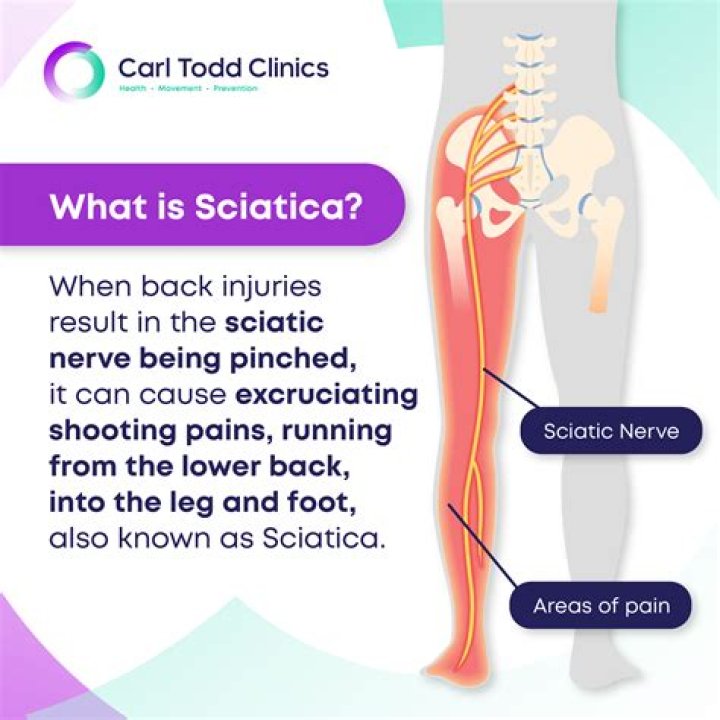 Where is sciatica pain felt?