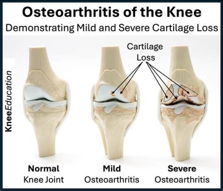 Where is the best place to live if you have severe arthritis?