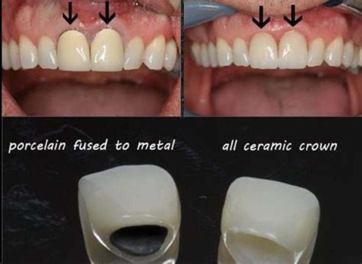 Which is stronger cement or ceramic?