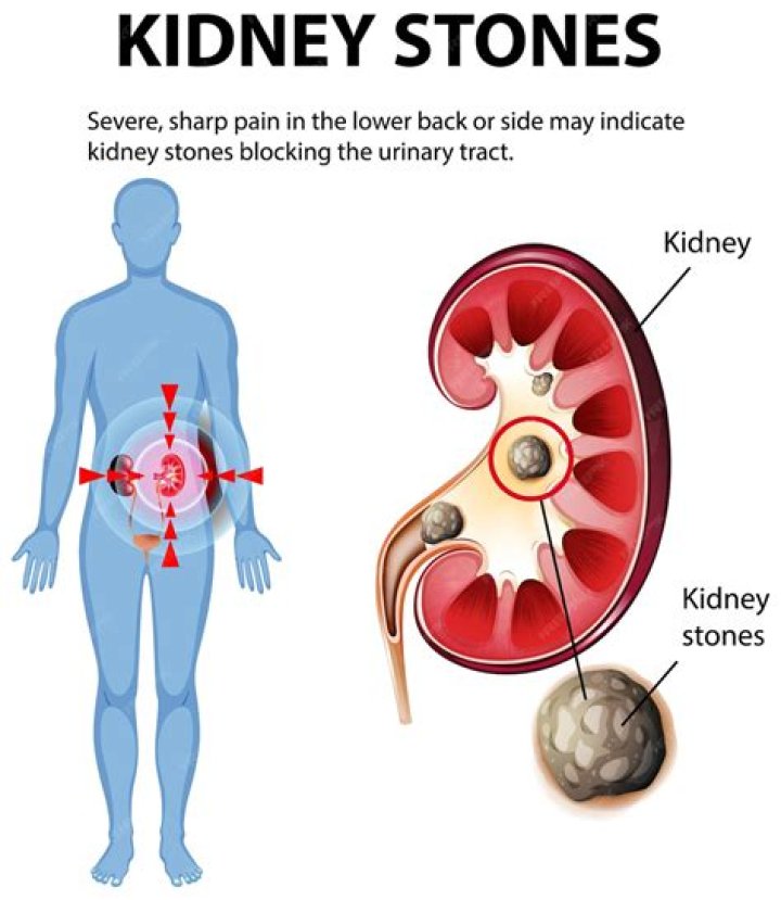 Which painkiller is best for kidney stones?
