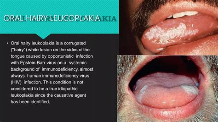 Which type of candidiasis is associated with leukoplakia?