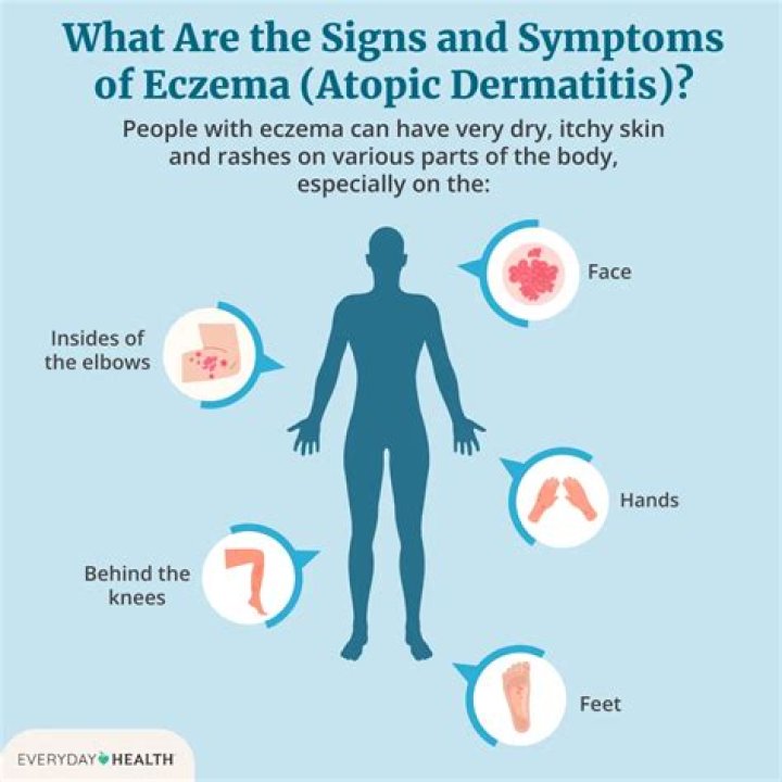 Why am I suddenly getting eczema?