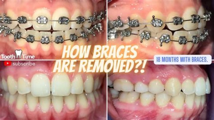Why are my teeth getting smaller with braces?