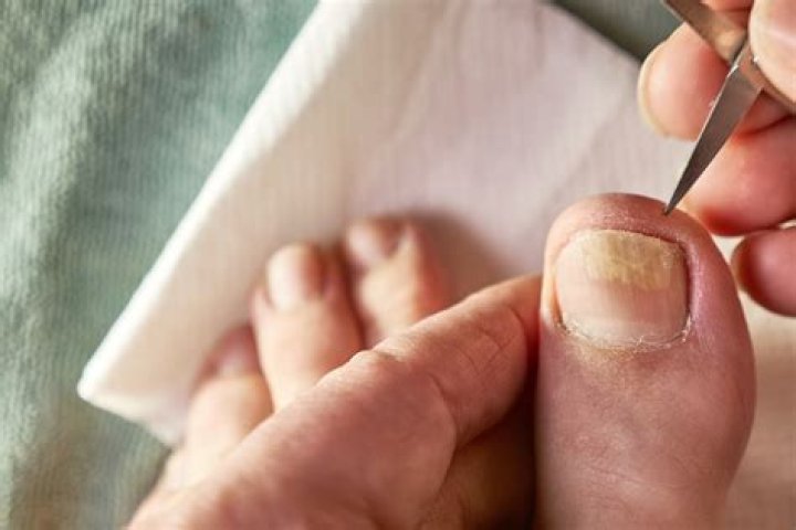 Why are my toenails yellowish brown?