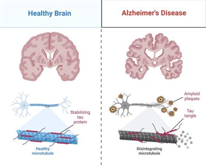 Why do Alzheimer's patients not sleep at night?