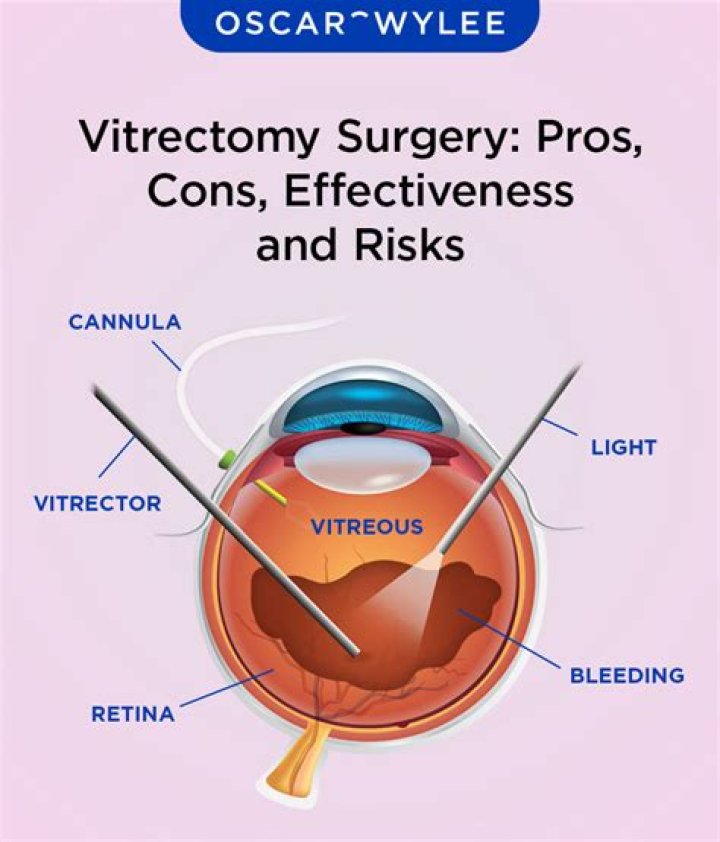 Why do I have poor vision after vitrectomy?