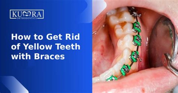 Why do my teeth look yellow with braces?