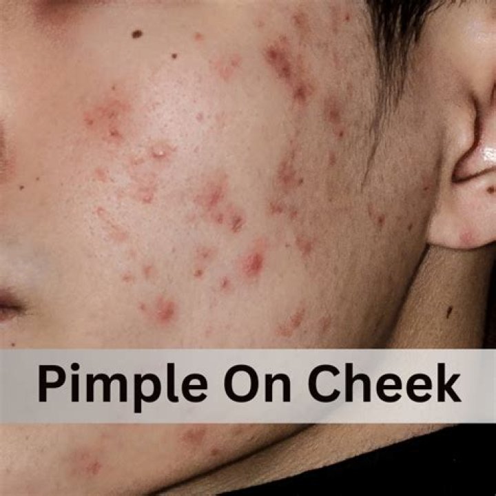 Why do pimples come on face?