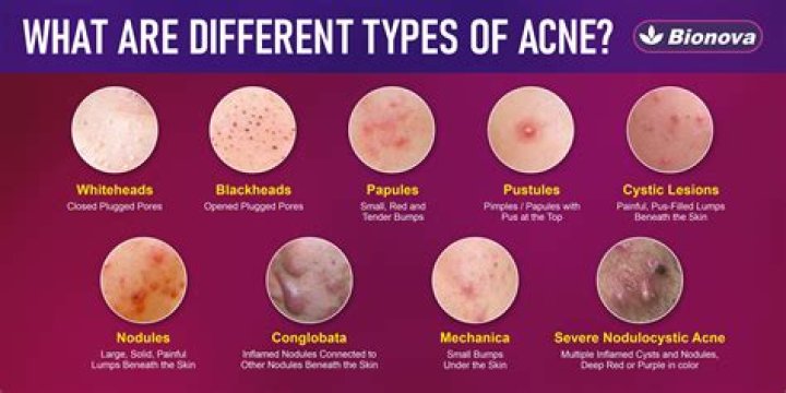 Why do redheads have acne?