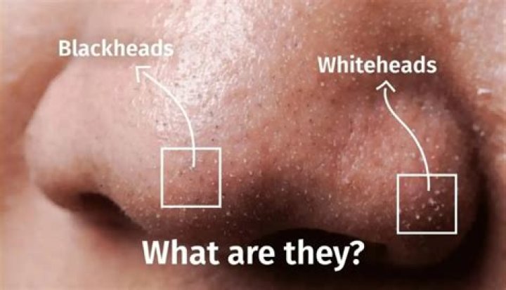 Why do the Whiteheads on my chin smell?