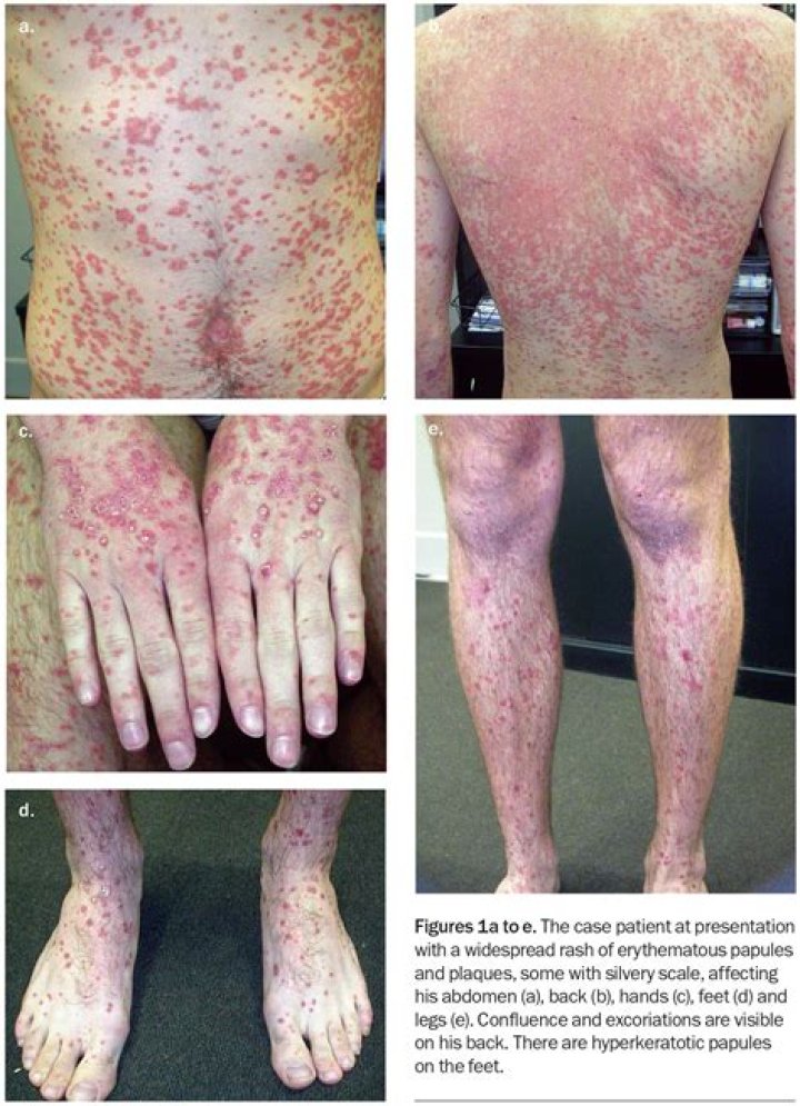 Why do they put ice on hands and feet during chemo?