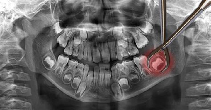 Why do we have wisdom teeth?