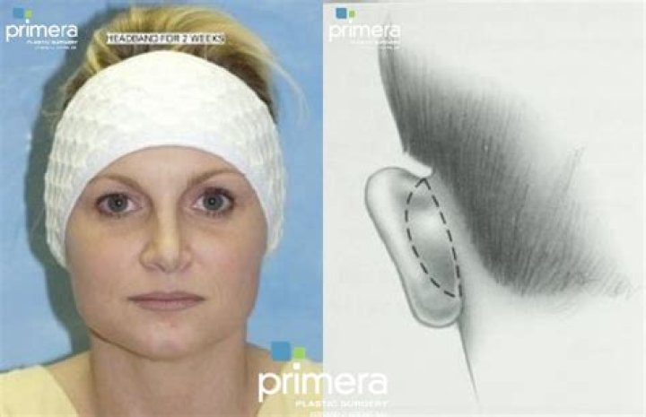 Why do you have to wear a headband after otoplasty?
