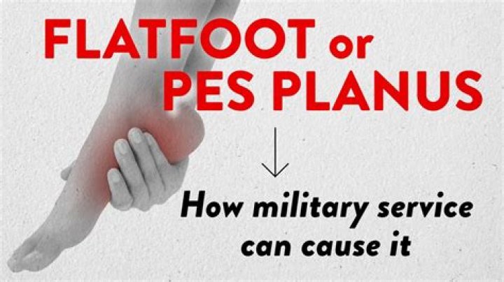 Why does flat feet disqualify you from the military?
