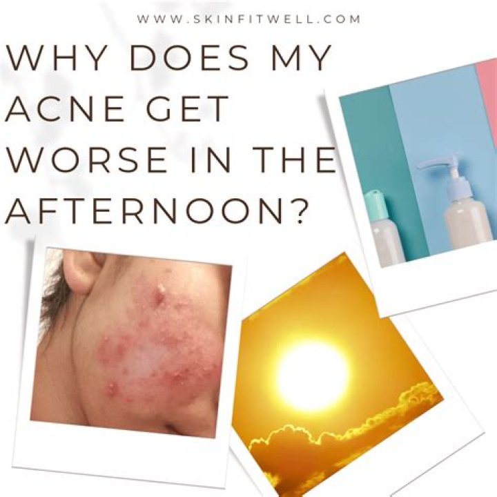 Why does my acne look worse after washing my face?
