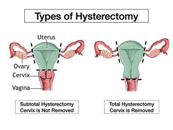 Why does my back hurt after hysterectomy?