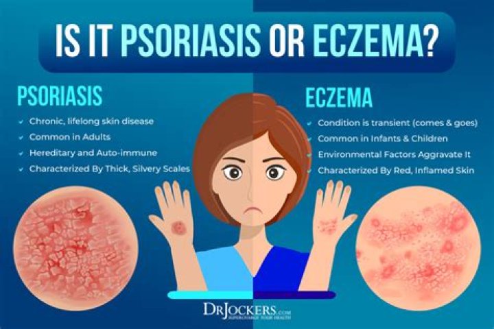 Why does my eczema burn?