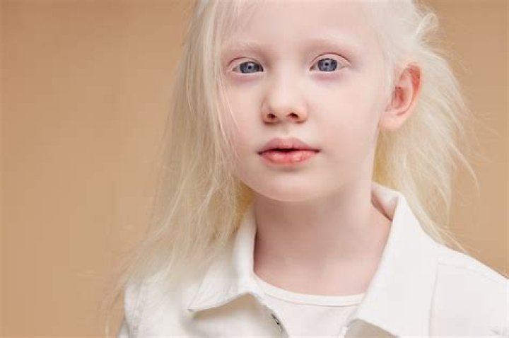 Why is being albino a disability?