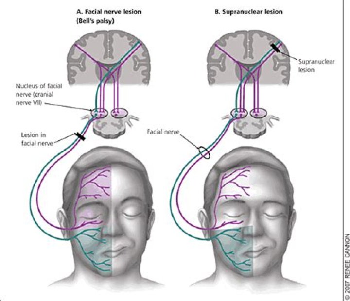 Why is forehead spared in stroke?