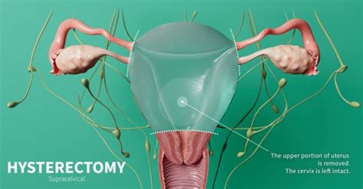 Why is LEEP done before hysterectomy?
