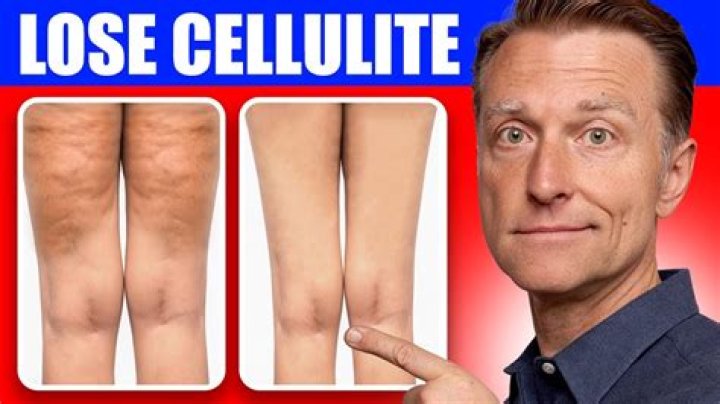 Why is my cellulite getting worse as I lose weight?