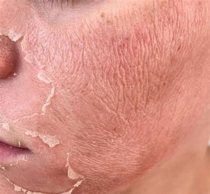 Why is my glaze peeling?